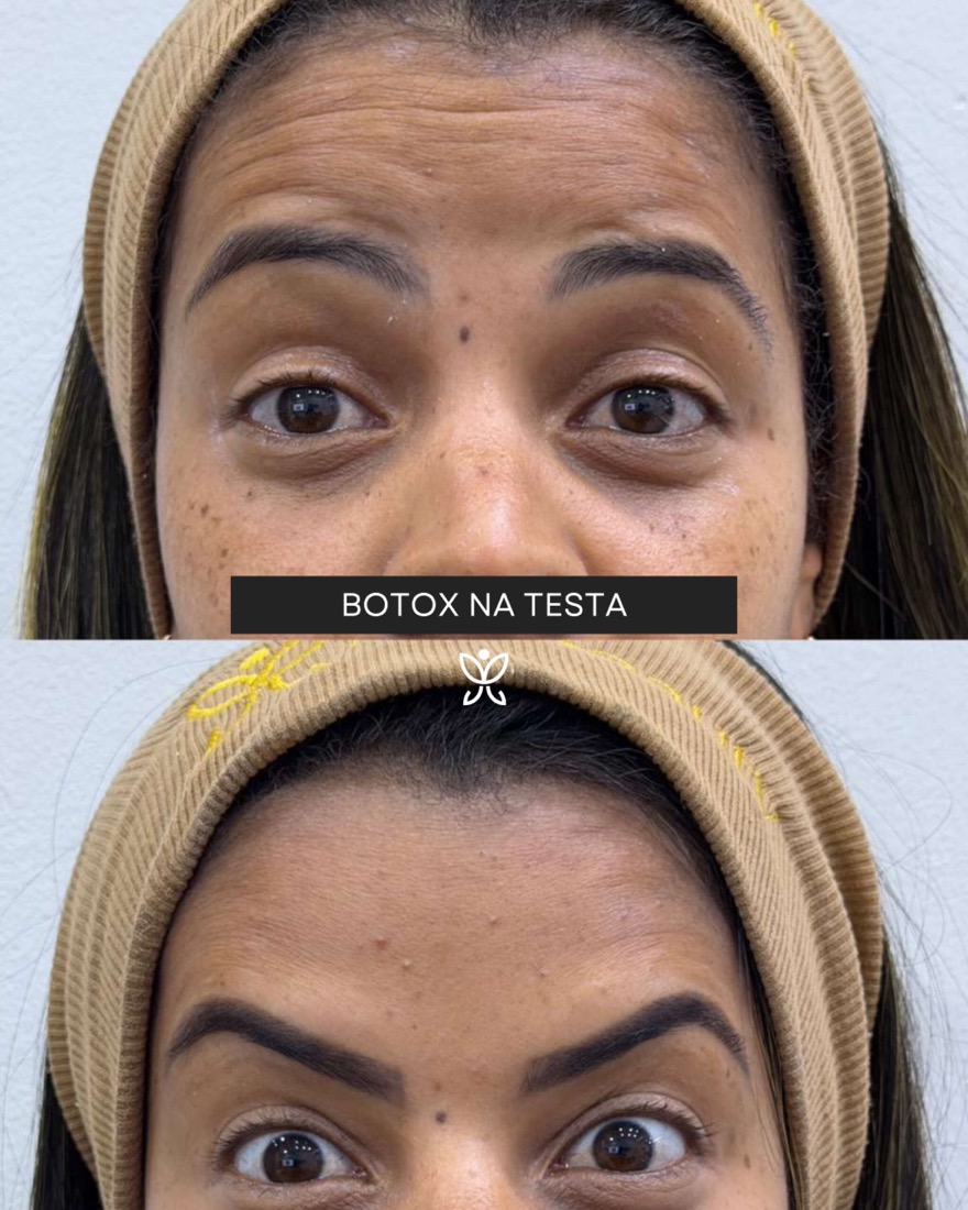 Antes e depois de paciente MF Beauty