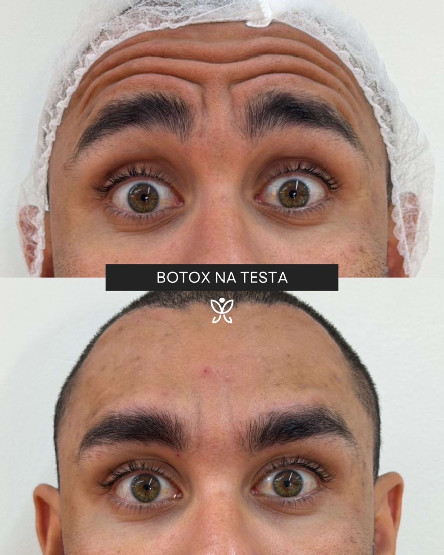 Antes e depois de paciente MF Beauty